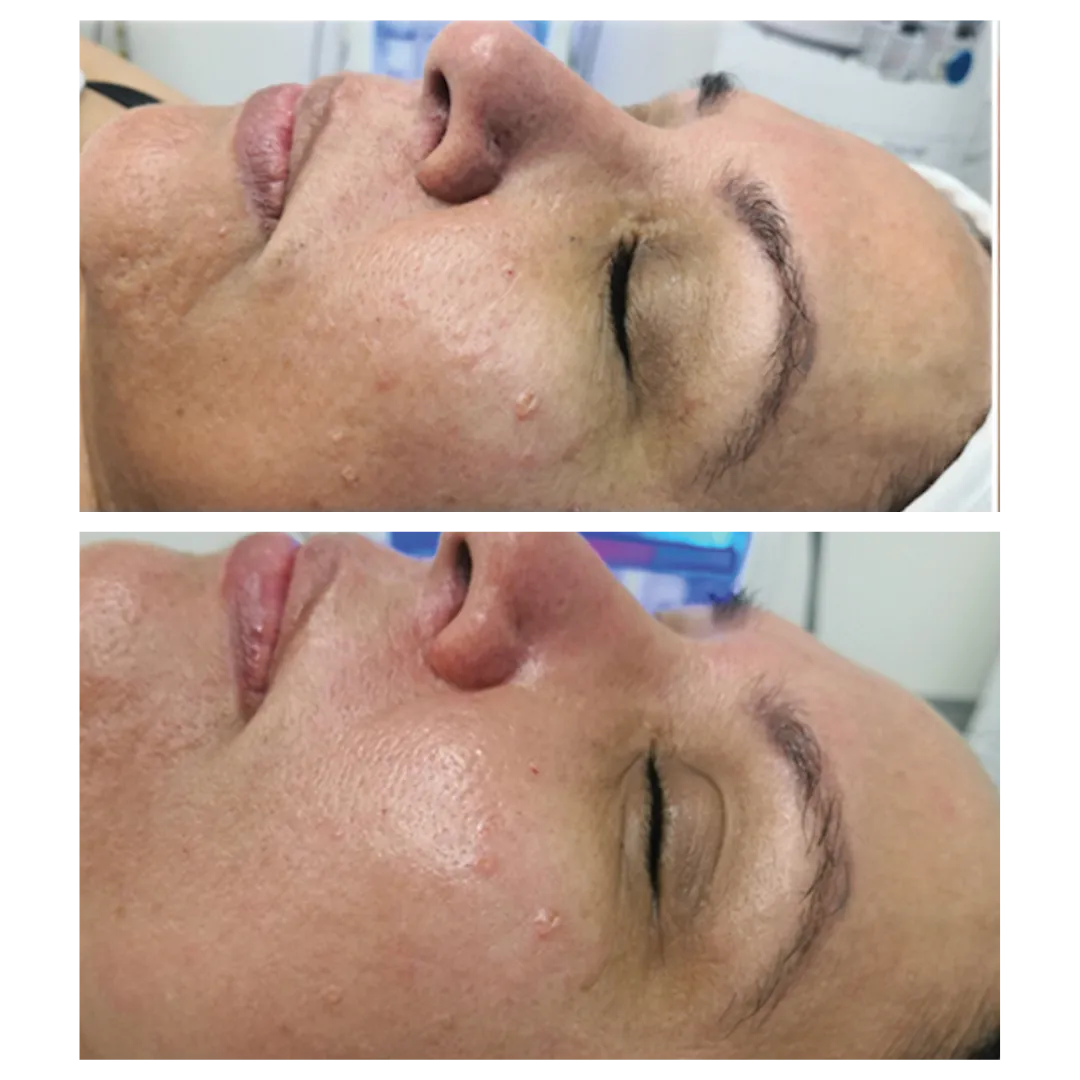 Detox facial | Nuovo Te | Madison, WI