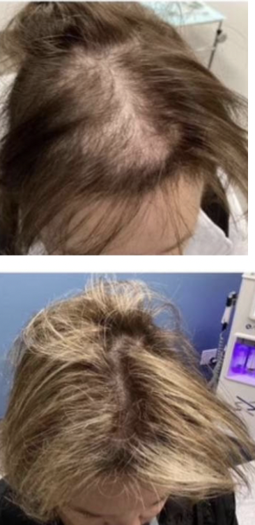 Hair Loss Treatment