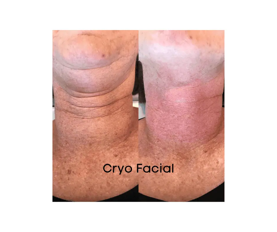 Cryo Facial (10)