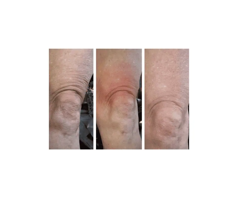 Cryo Facial (12)