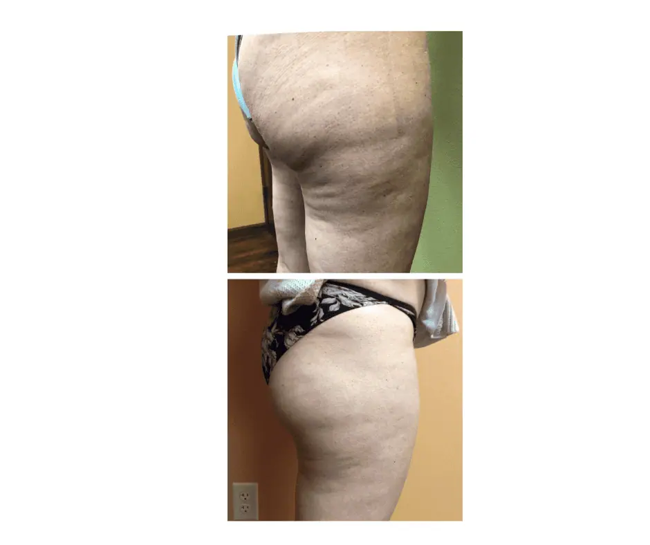 Cryo Facial (14)