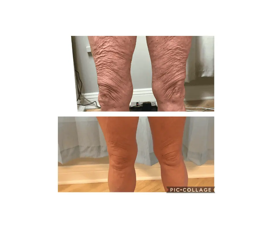 Cryo Facial (3)