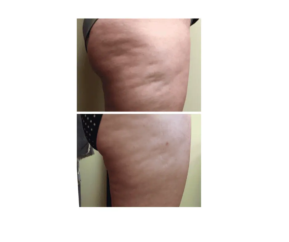 Cryo Facial (4)