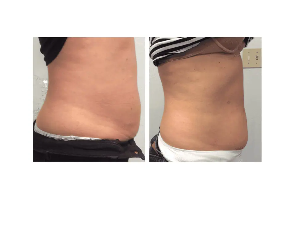 Cryo Facial (7)