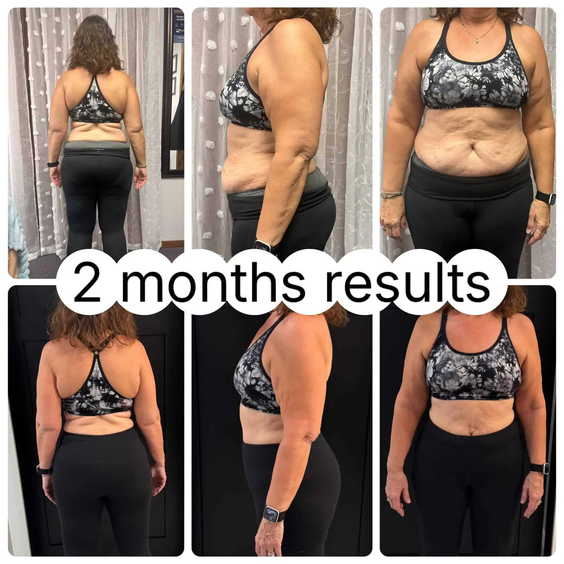 Peptides for Weight Loss in Madison, WI-Before-After (1)